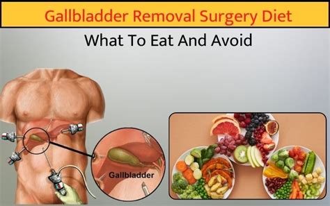 Common Pitfalls: What to AVOID When Navigating Your Gallbladder Diet